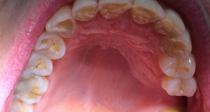 Lähikuva auki olevasta suusta, josta näkyvät eroosion kuluttamat hampaat.