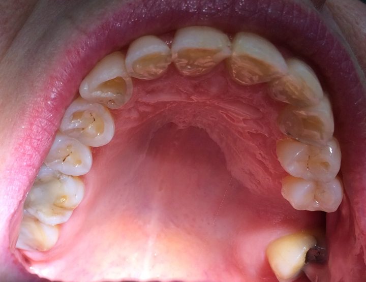 Lähikuva auki olevasta suusta, josta näkyvät eroosion kuluttamat hampaat.