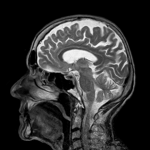 A saggital MRI scan of the brain